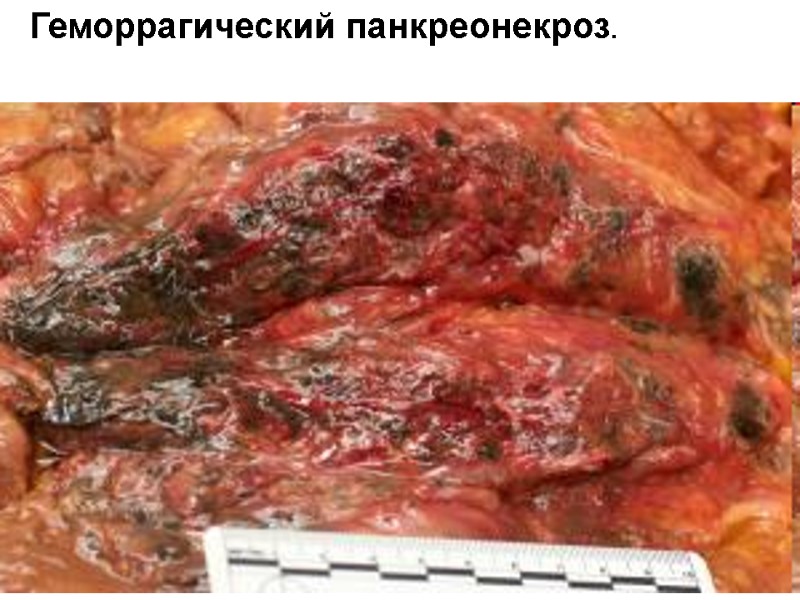 Геморрагический панкреонекроз.